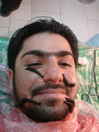 خواص زالو انداختن برای پوست صورت خواص زالو انداختن برای پوست صورت